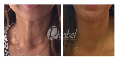 REJUVENECIMIENTO DE CUELLO